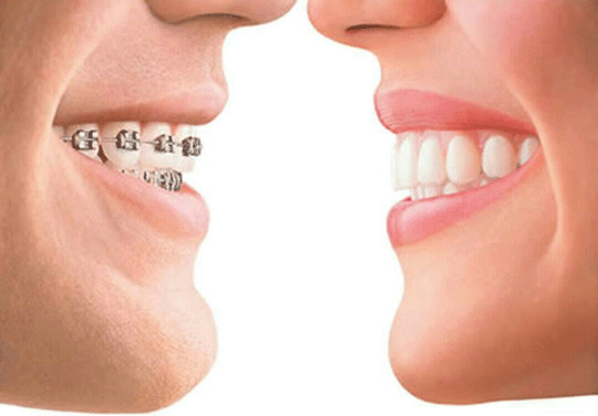 Alasan Orang Memakai Kawat Gigi
